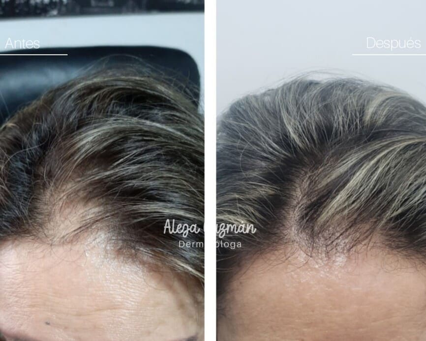 Imagen tratamiento caída del cabello alopecia