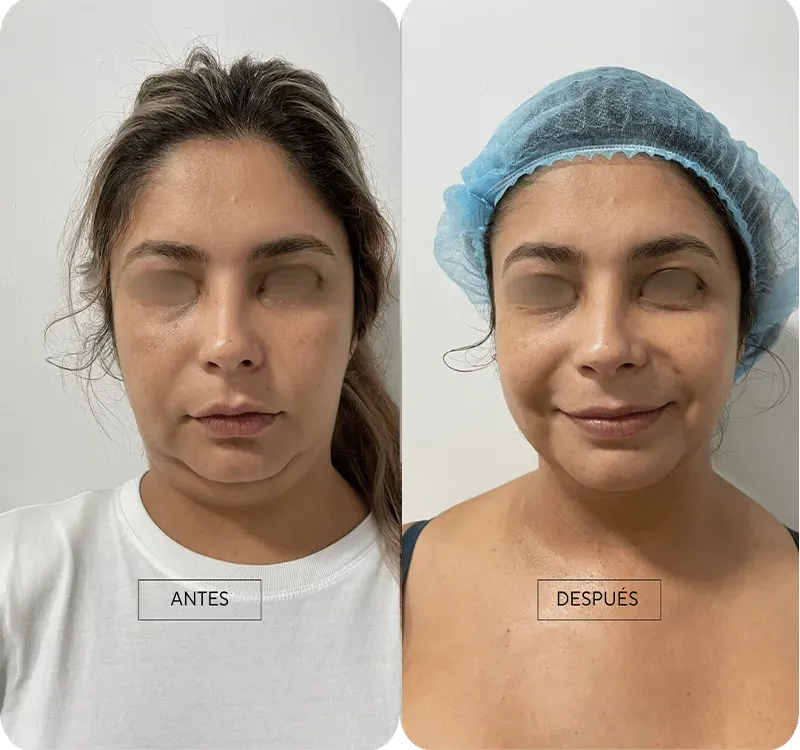 Img-Dra_Alejandra_Guzmán-Tecnología-Contour_Pro-1
