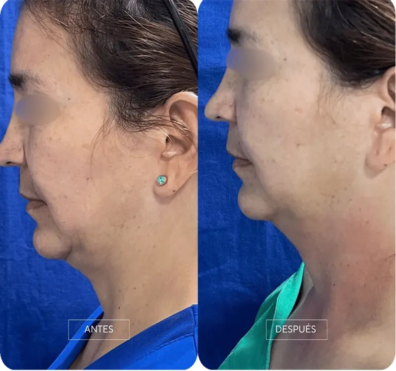Img-Dra_Alejandra_Guzmán-Tecnología-Contour_Pro-3
