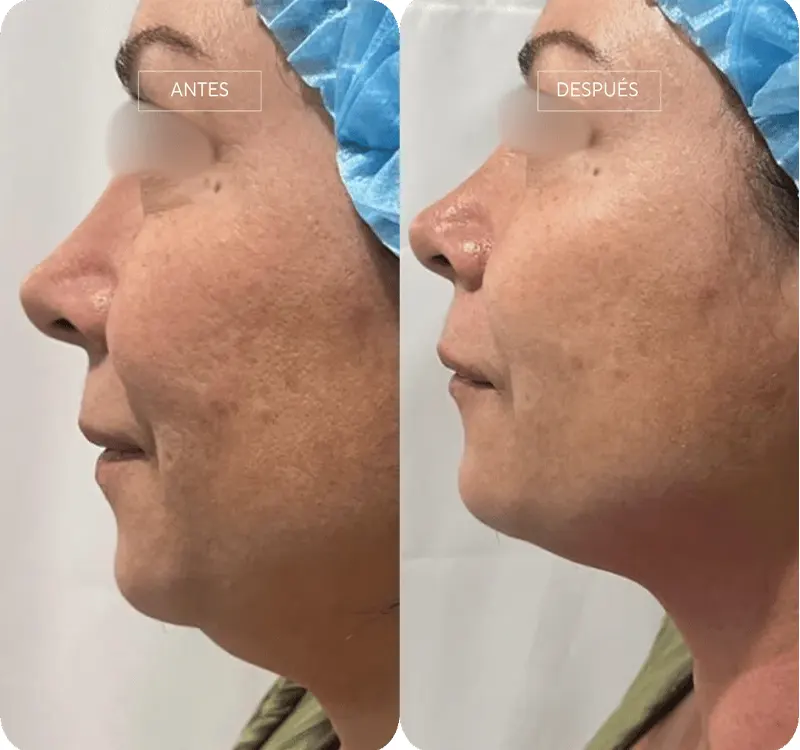 Img-Dra_Alejandra_Guzmán-Tecnología-Contour_Pro-5
