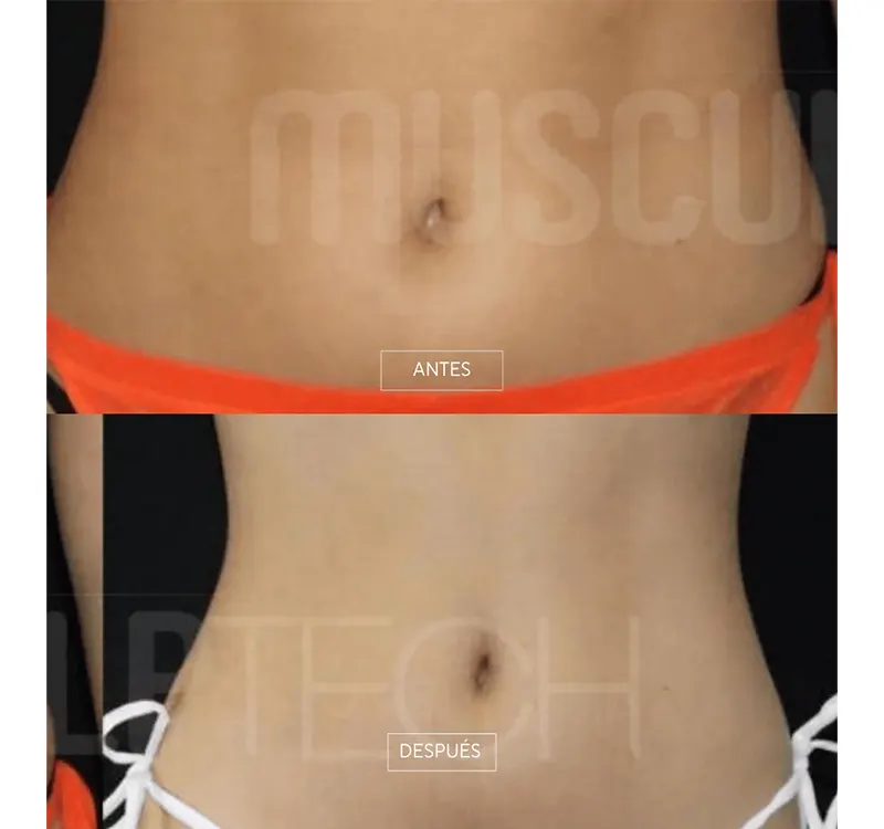 Img-Dra_Alejandra_Guzmán-Tecnología-Musculptech-7
