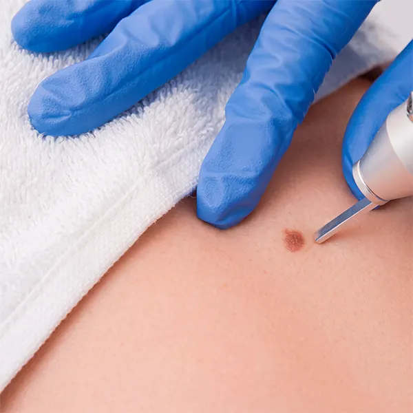 Img-Procedimientos_Dermatologicos-Crioterapia