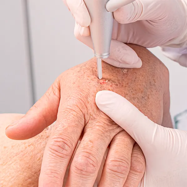 Img-Procedimientos_Dermatologicos-Electrocauterio