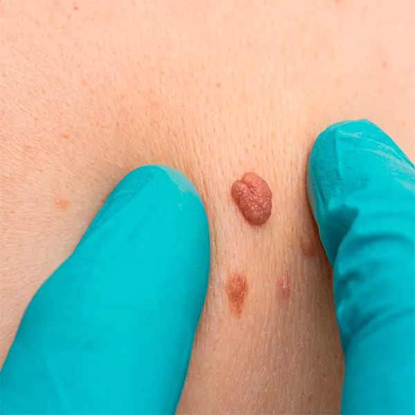 Img-Procedimientos_Dermatologicos-Tumores
